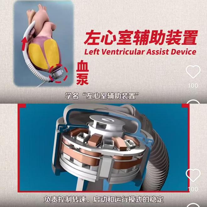 「深度」国产人工心的商业暗战(图1)